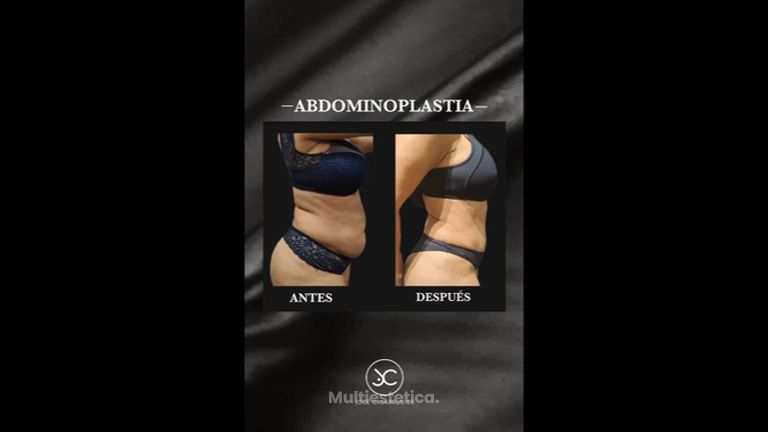 Abdominoplastia - Dr. Jose Casarrubios