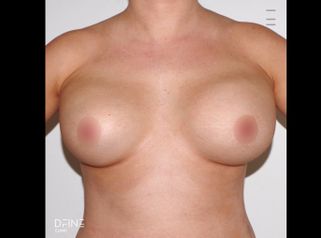 Aumento de pecho - Dfine Clinic