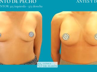 Aumento de pecho - Clínica Dr. Pascual Marín