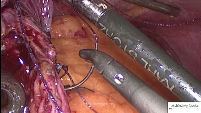 By pass gástrico con hernia de hiato - Dr. David Martinez Cecilia