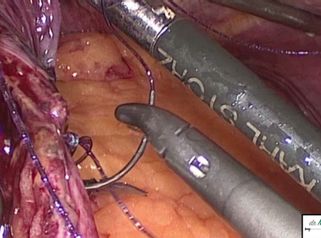 By pass gástrico con hernia de hiato - Dr. David Martinez Cecilia