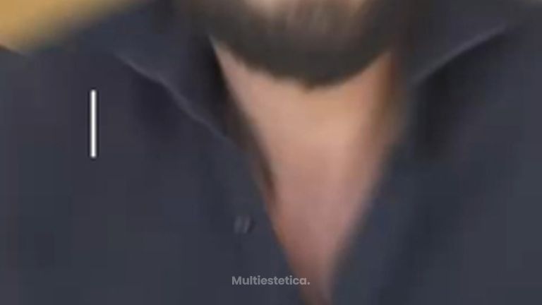 Que es el endolifting