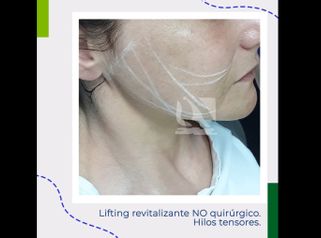 Hilos tensores faciales - Centro Clínico Quirúrgico Aranjuez