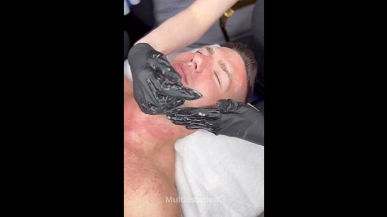 Hydrafacial - Clínica Gove