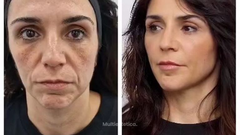 Clínica Carlos Gómez - Antes y después de tratamiento de rejuvenecimiento facial.