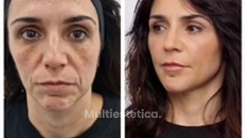 Clínica Carlos Gómez - Antes y después de tratamiento de rejuvenecimiento facial.