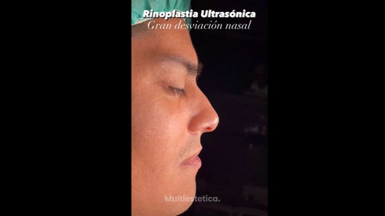 Rinoplastia - Dr. Alberto Candau