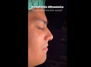 Rinoplastia - Dr. Alberto Candau