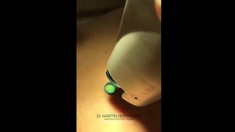Lunares - Dr. Martín Hernández