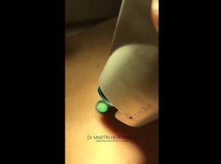 Lunares - Dr. Martín Hernández