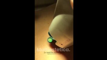 Lunares - Dr. Martín Hernández