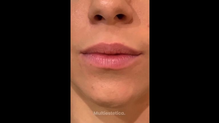 Aumento de labios - Dr. Juan Enrique Pérez Enríquez