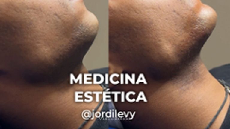 Armonización facial - Clínica Opción Médica