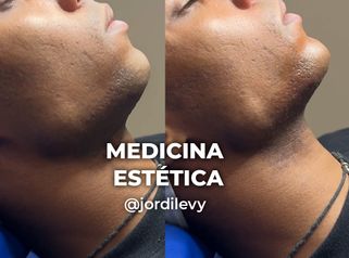 Armonización facial - Clínica Opción Médica