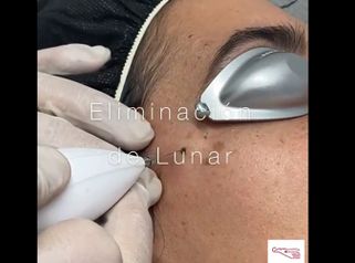 Lunares - Clínica De Medicina Estética Córdoba