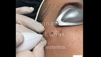 Lunares - Clínica De Medicina Estética Córdoba