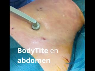 BodyTite en abdomen - Dra. Ana Martinez Padilla