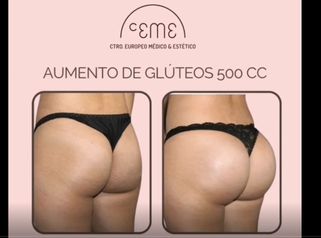 Aumento de glúteos 