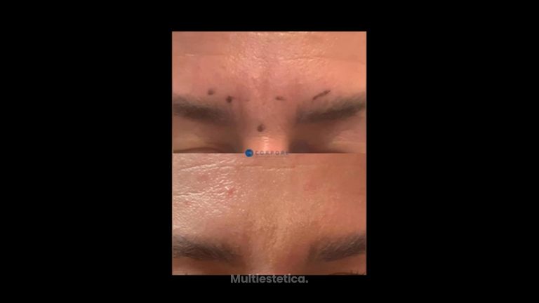 Rellenos faciales - Dr. Juan Enrique Pérez Enríquez