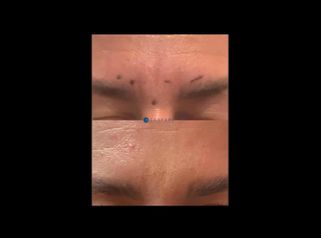 Rellenos faciales - Dr. Juan Enrique Pérez Enríquez