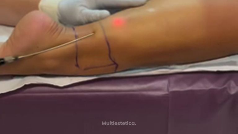 🔍 SmartLipo en Gemelos- ¿Es posible ¡Sí, y cada vez más pacientes lo eligen! 💉💪