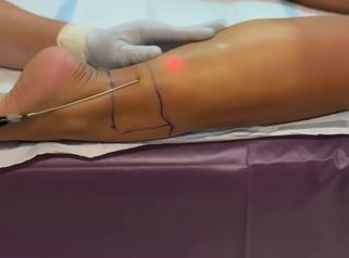 🔍 SmartLipo en Gemelos- ¿Es posible ¡Sí, y cada vez más pacientes lo eligen! 💉💪