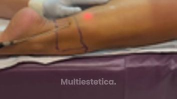 🔍 SmartLipo en Gemelos- ¿Es posible ¡Sí, y cada vez más pacientes lo eligen! 💉💪