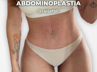 Abdominoplastia - Clínica Opción Médica