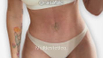 Abdominoplastia - Clínica Opción Médica