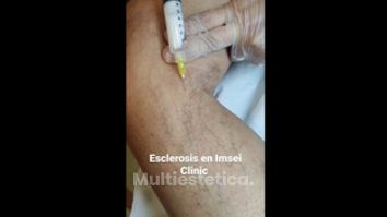 Esclerosis - IMSEI CLINIC