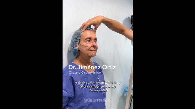 Blefaroplastia - Dr. Jiménez Ortiz