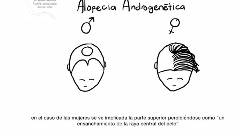 Alopecia Androgenética - CCCI Grupo Tufet