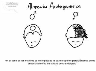 Alopecia Androgenética - CCCI Grupo Tufet