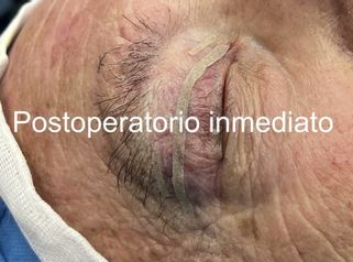 Diseño de una Blefaroplastia superior - Dr. Joshi Otero