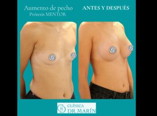Aumento de pecho - Clínica Dr. Pascual Marín