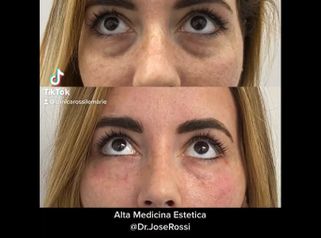 Eliminación de las ojeras - Clínica Rossi Lemarie