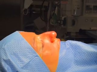 Rinoplastia - Clinica Silvia Roson