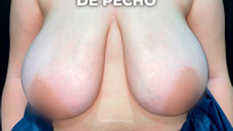 Reducción mamaria - Clínica Opción Médica