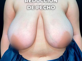 Reducción mamaria - Clínica Opción Médica