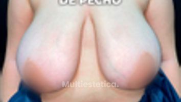 Reducción mamaria - Clínica Opción Médica