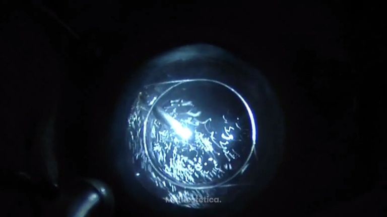 Así es una vitrectomía en membrana epirretiniana con Hialosis Asteroide