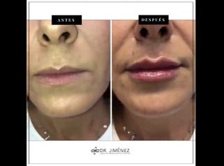 Aumento de labios - Clínica Dr. Jiménez