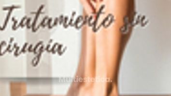 Tratamiento de varices sin cirugia