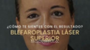 Blefaroplastia Láser Superior