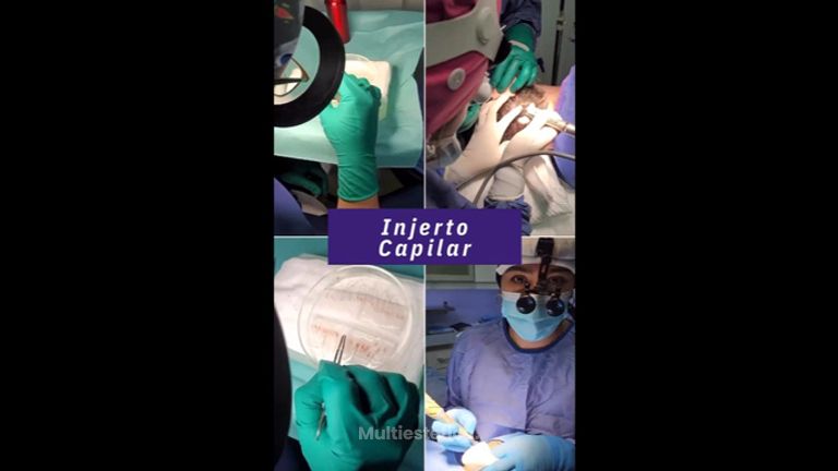 Implantes capilares - Clínica Tarrazo