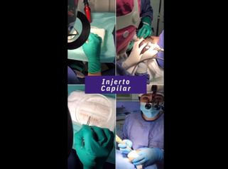 Implantes capilares - Clínica Tarrazo