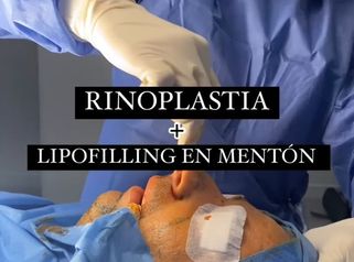 Rinoplastia - Clínica Dr. Jiménez