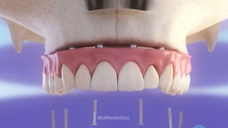 Los implantes dentales, perfectos para mejorar tu sonrisa