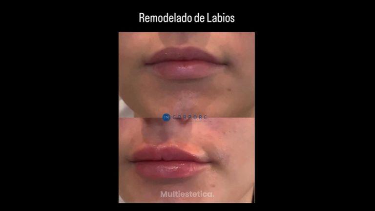 Aumento labios - Dr. Juan Enrique Pérez Enríquez