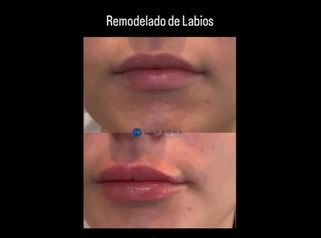 Aumento labios - Dr. Juan Enrique Pérez Enríquez